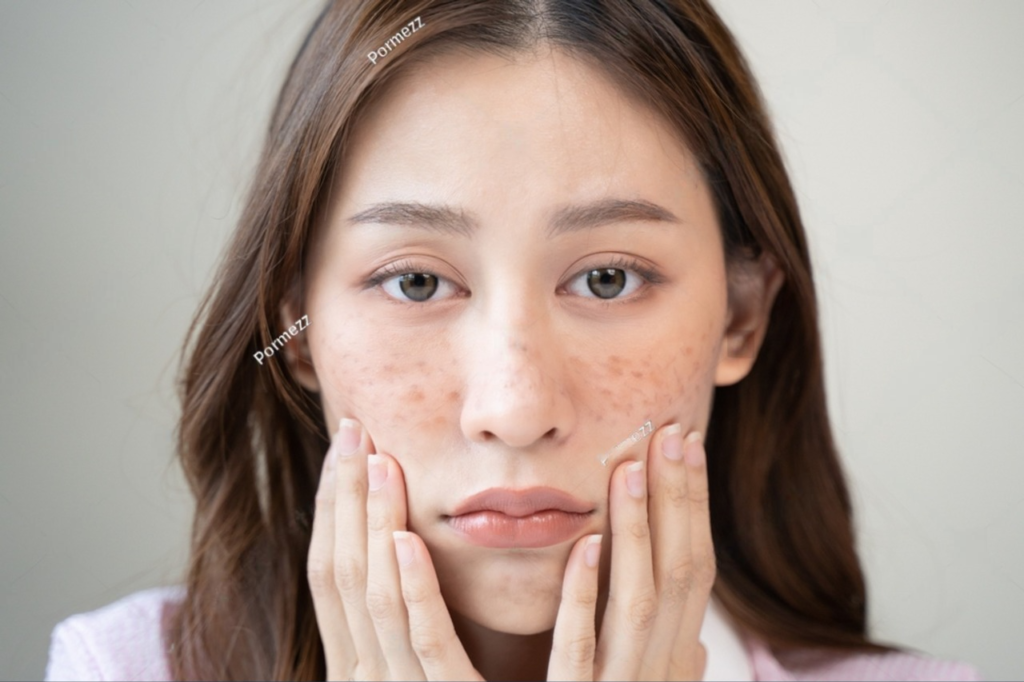 Melasma adalah kondisi kulit yang menyebabkan munculnya bercak-bercak gelap pada kulit, terutama di area wajah seperti pipi, dahi, dan dagu.